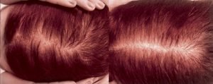 alopecia-fem